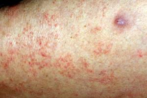 Picture of scabies rash on the arm, consisting of tiny red spots