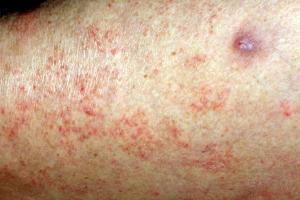 Scabies rash on the arm, consisting of tiny red spots Picture of scabies rash on the arm, consisting of tiny red spots