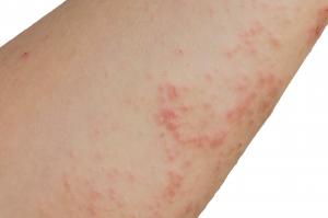 Picture showing scabies rash on an arm, consisting of tiny red spots