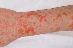 Picture showing pink-red rash of scarlet fever