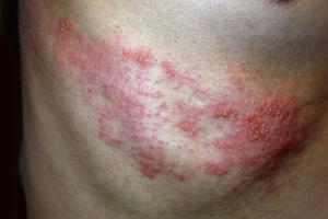 Picture of Shingles causing a red rash, forming a strip on the skin of a chest wall