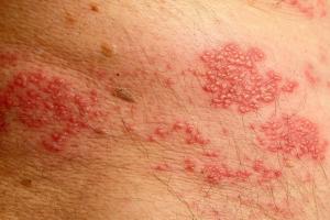 Picture of shingles rash on the skin close up