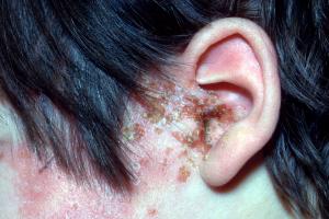 Picture of shingles rash on the side of the face and ear