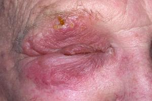Picture of an eye affected by shingles