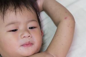 Picture of a baby infected with hand foot and mouth disease