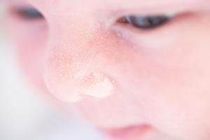 Picture of a nose showing milk spots (milia) Picture of nose showing milk spots