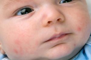 Baby’s face with red rash, acne and pimples, commonly known as ‘baby acne’ Baby’s face with red rash, acne and pimples, commonly known as ‘baby acne’