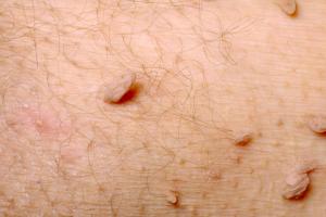 Picture showing skin tags