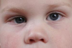 A child with a squint in its right eye