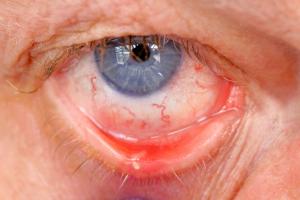 Picture showing a stye on the lower eyelid