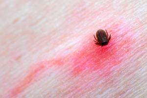 Tick feeding on skin with inflamed area around bite