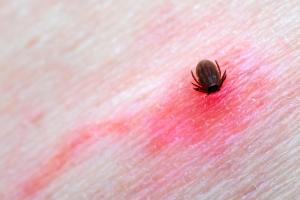Tick feeding on skin with inflamed area around bite Tick feeding on skin with inflamed area around bite