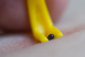 Tick being removed by using a tick removal tool Removal of a tick from human skin using a special plastic tool