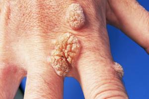 Picture showing warts on hand