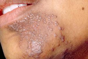 picture showing flatter warts on a face