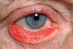 Ectropion affecting the lower eyelid