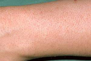 Arm with keratosis pilaris Picture showing arm with keratosis pilaris
