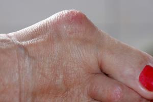 Picture of a bunion showing hard, red skin over the lump