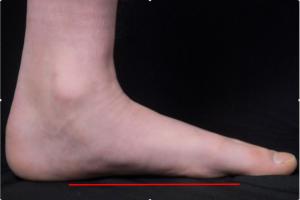 Side view of a boy’s flat feet 
