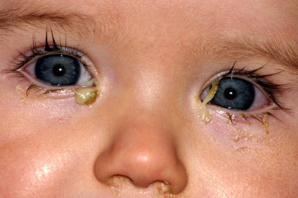 Conjunctivitis | nidirect