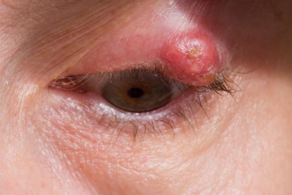 Eyelid problems | nidirect