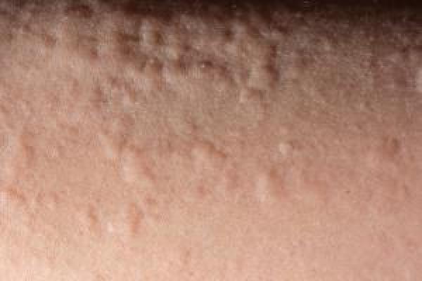 Urticaria Hives Nidirect