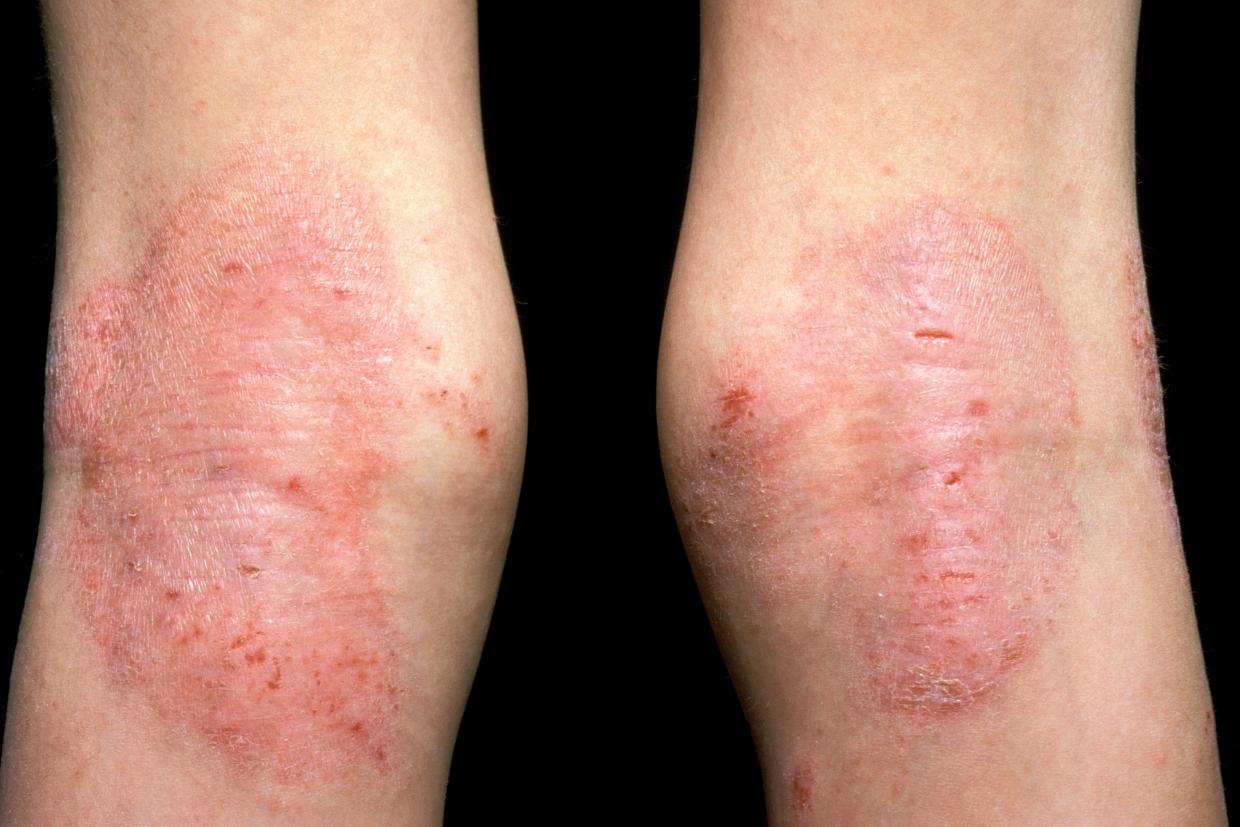 Eczema (atopic) nidirect