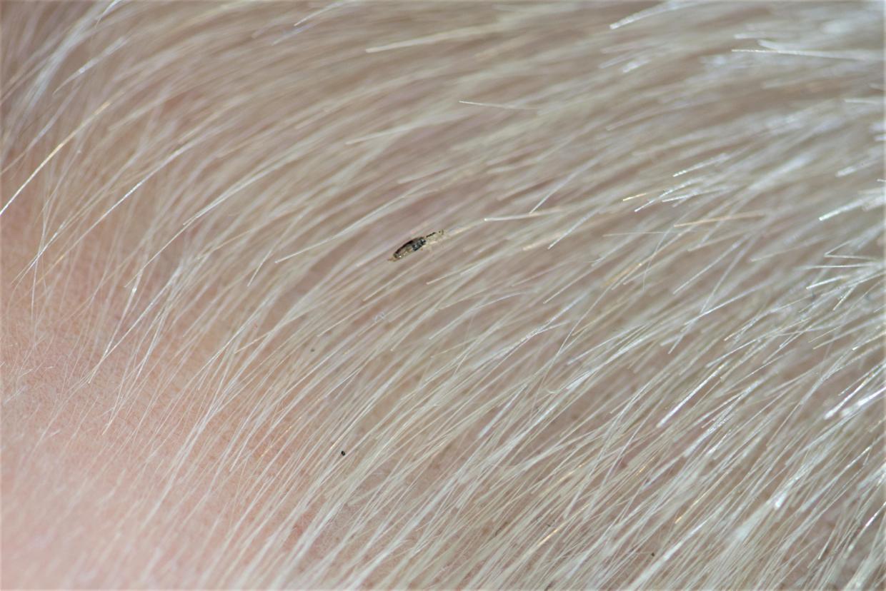 Head lice infection фотография Stock Adobe Stock