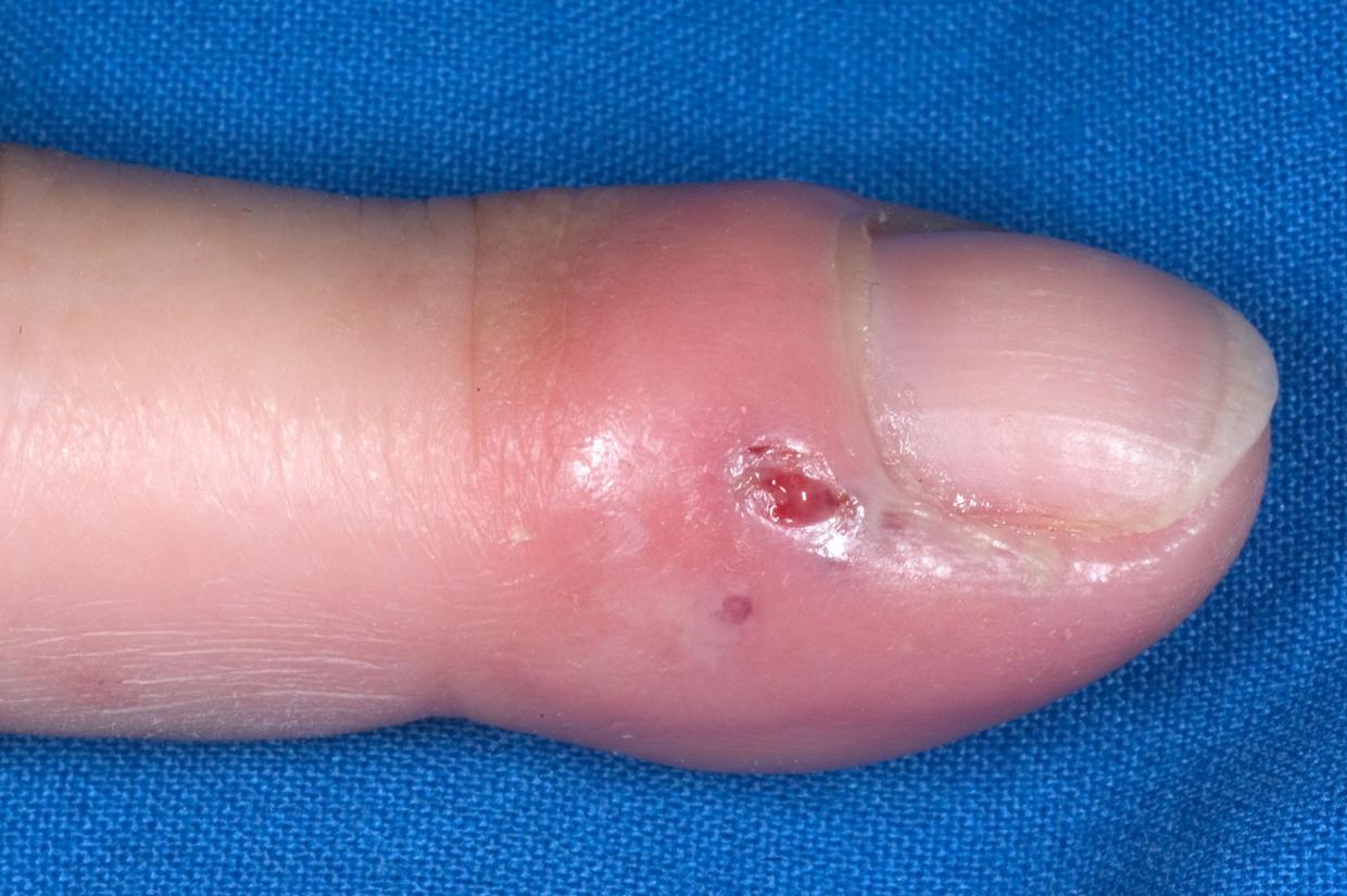 Herpetic whitlow (whitlow finger) nidirect