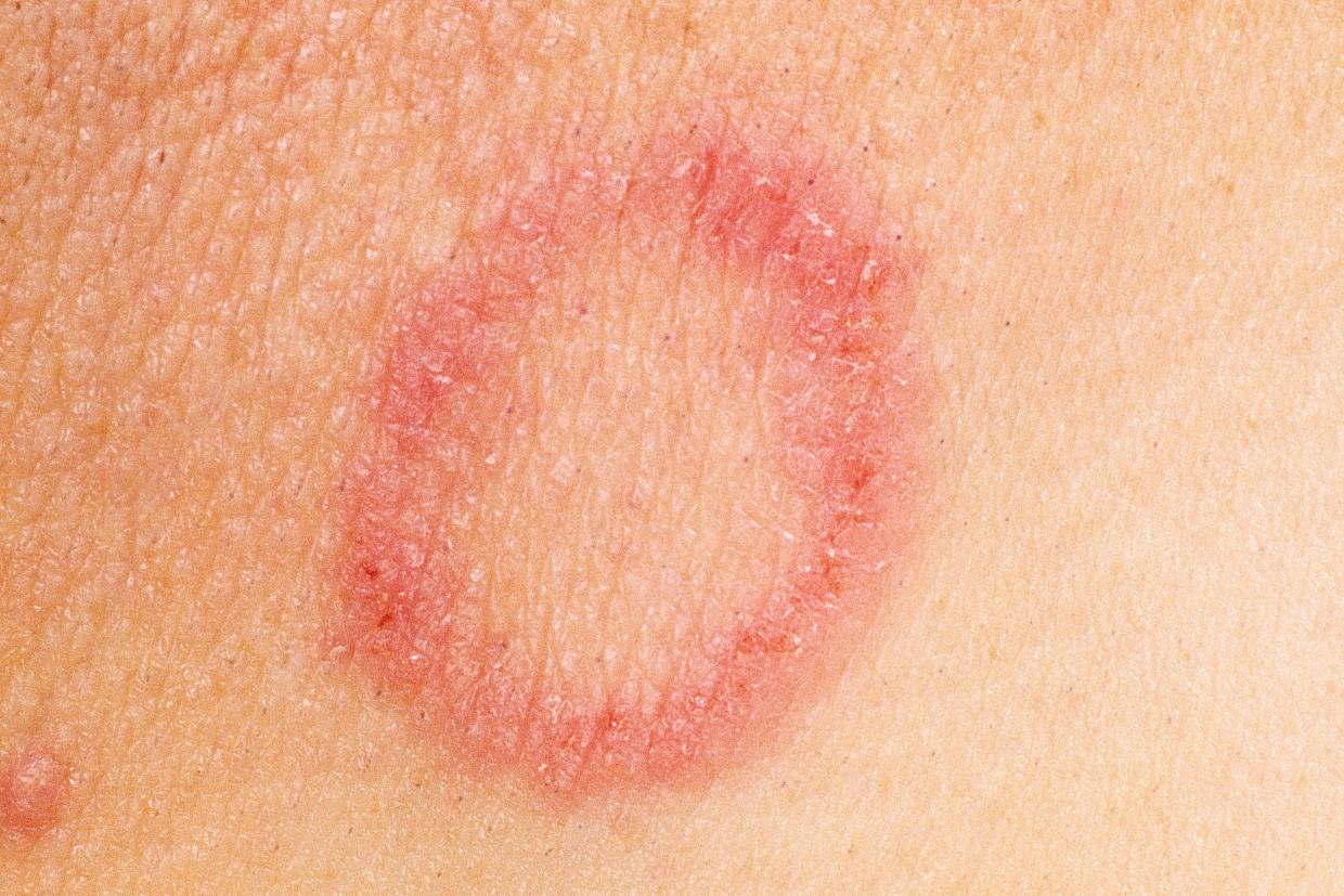Ringworm Nidirect Ringworm Nidirect