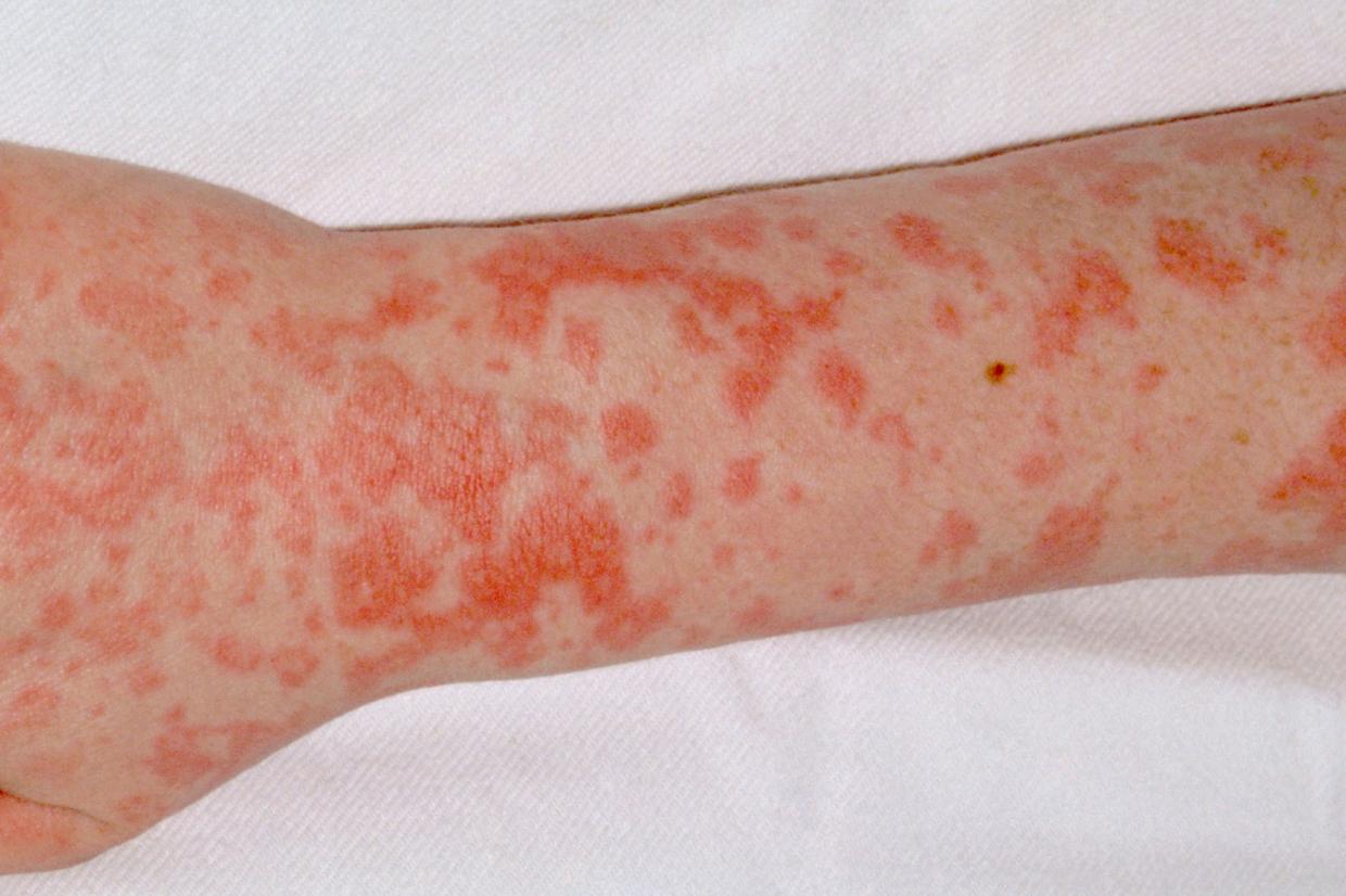 skin-rashes-in-children-nidirect