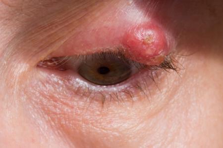 Eyelid problems | nidirect