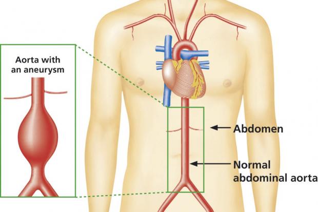 diagram showing the difference between a normal aorta and an aorta with an abdominal aneurysm