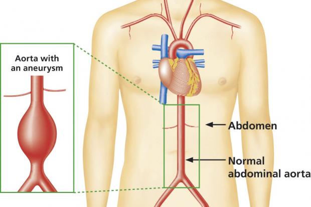 Diagram showing the difference between a normal aorta and one with an aneurysm diagram showing the difference between a normal aorta and an aorta with an abdominal aneurysm