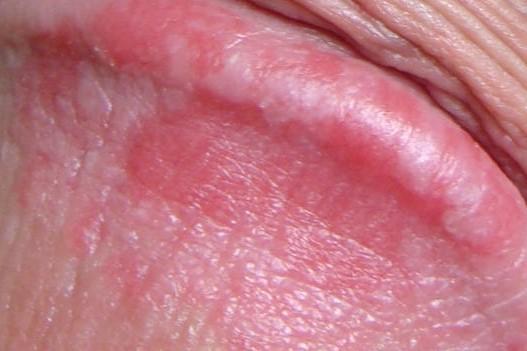 Balanitis affects the head of the penis and the foreskin. a sore, itchy and...