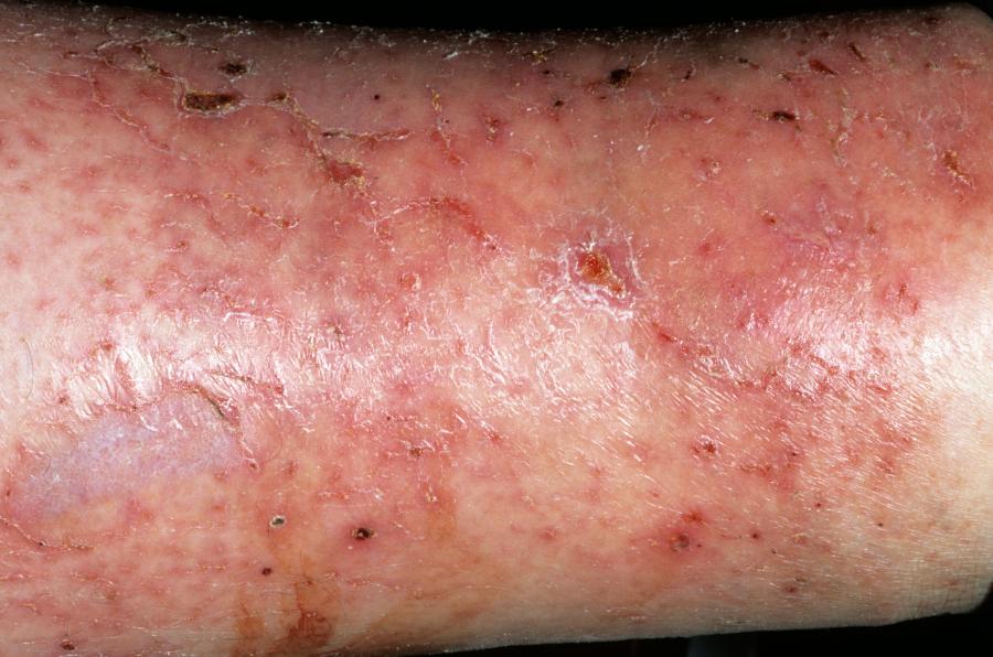 Cellulitis | nidirect