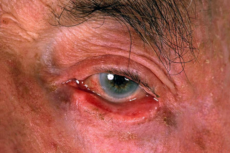 Eyelid problems nidirect