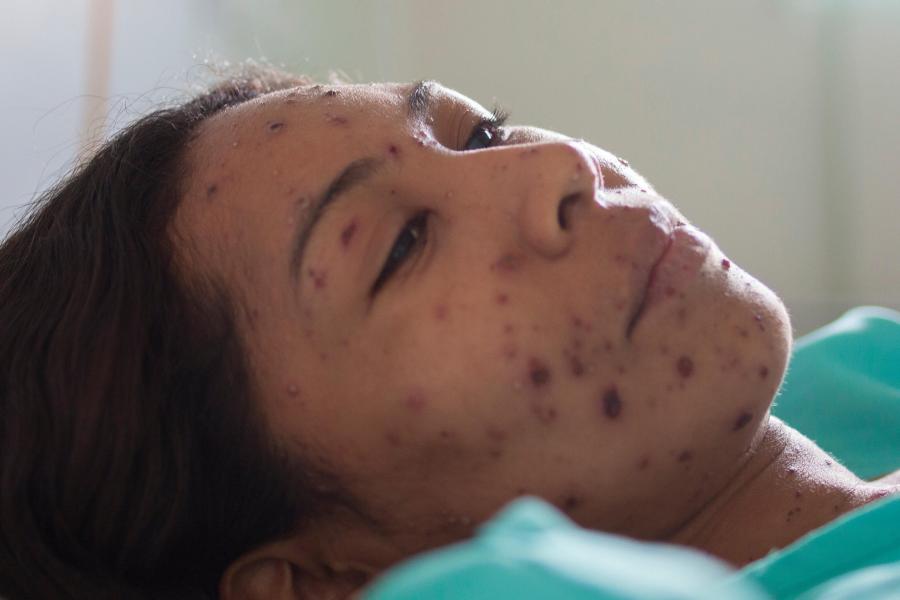 Measles nidirect