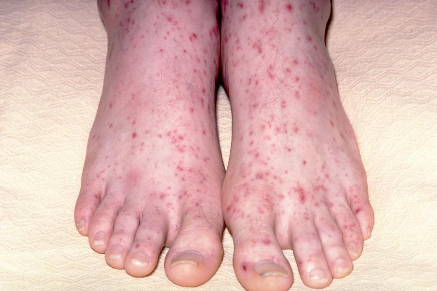 Meningitis Nidirect Meningitis Nidirect