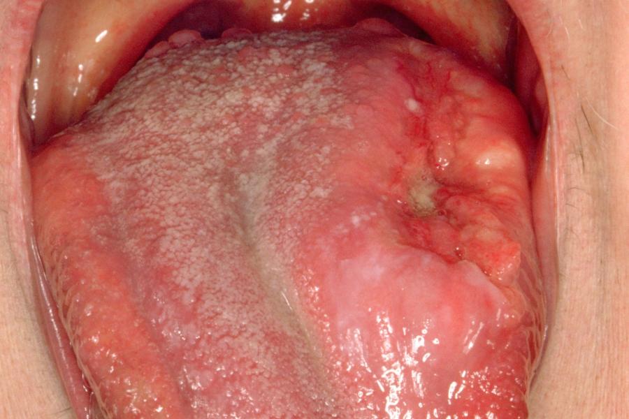 Mouth cancer (oral cancer) | nidirect