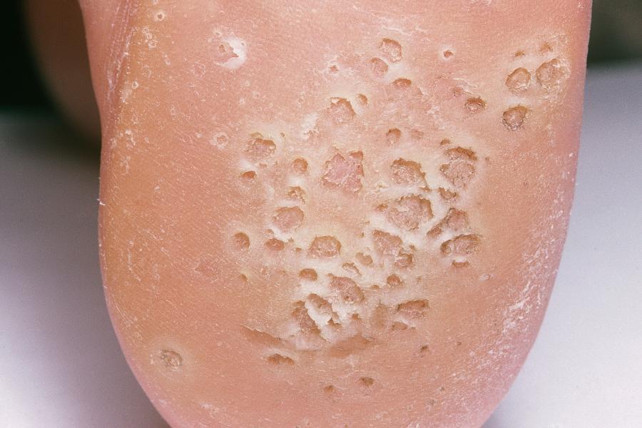 Warts and verrucas nidirect